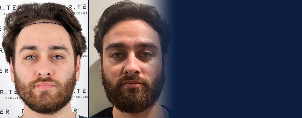 Before and after: a Dr. Terziler hair transplant patient on the day of surgery and at month 7