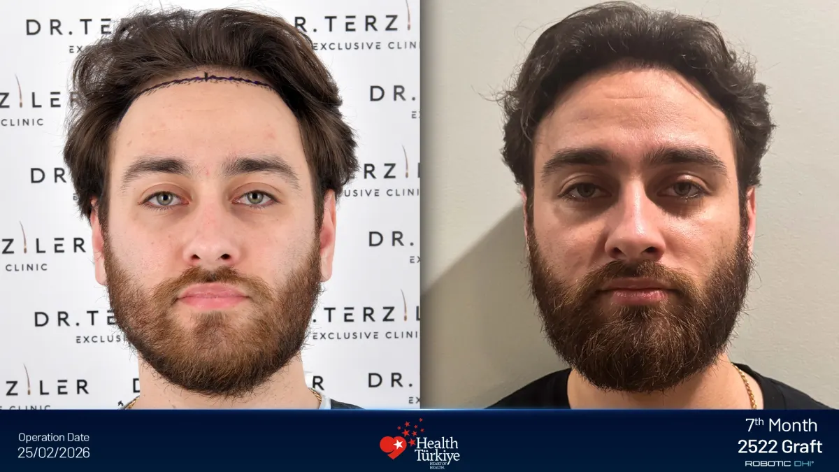 Robotic DHI hair transplant before and after at Dr. Terziler Exclusive Clinic: the same patient on the day of surgery and at month 7, 2,522 grafts