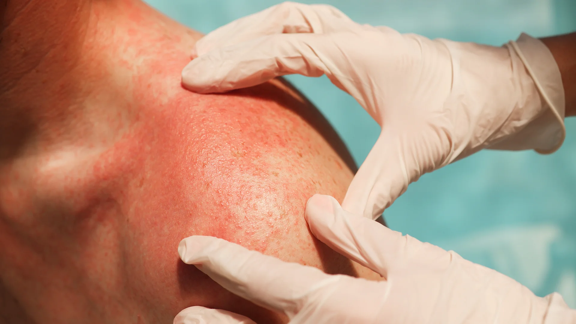 Maladies Cutanées Allergiques