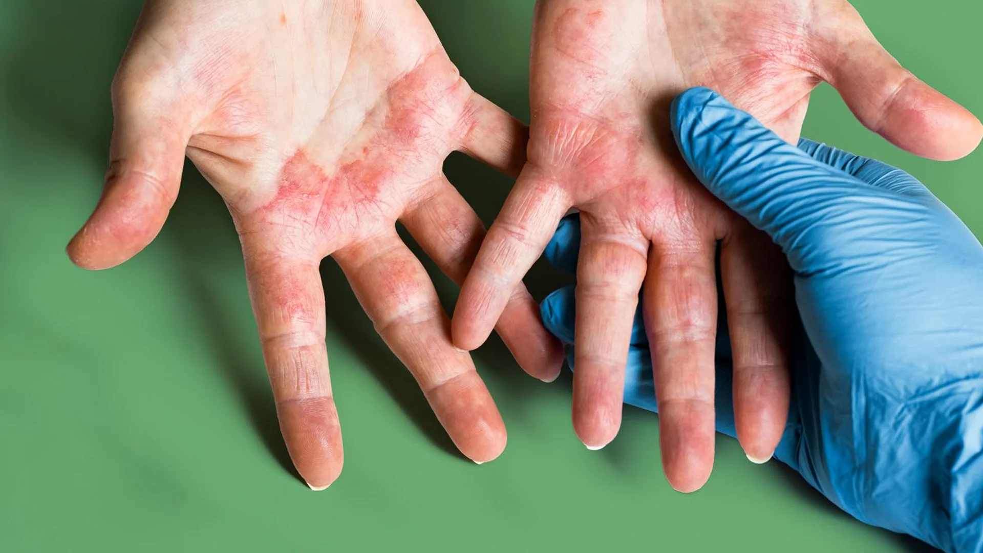 Traitement de l'Eczéma