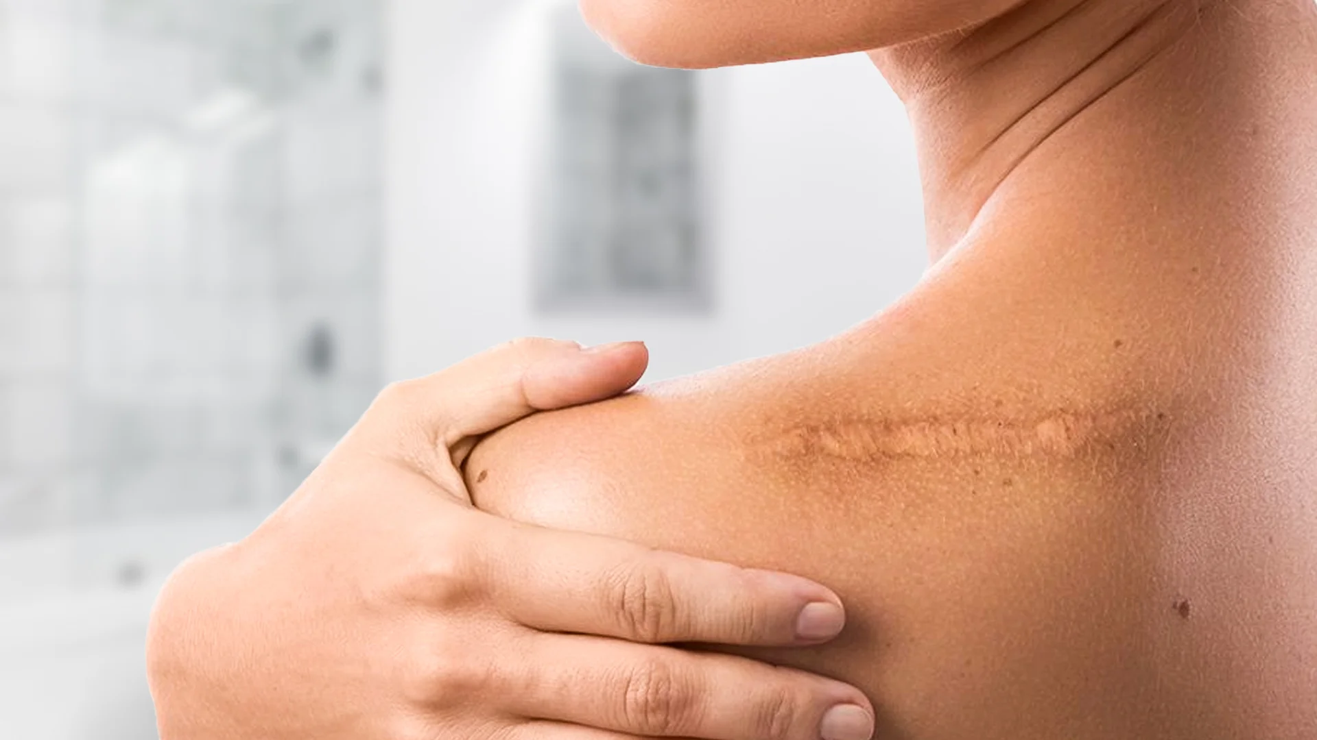 Traitement des Cicatrices (Cicatrices de Blessures)