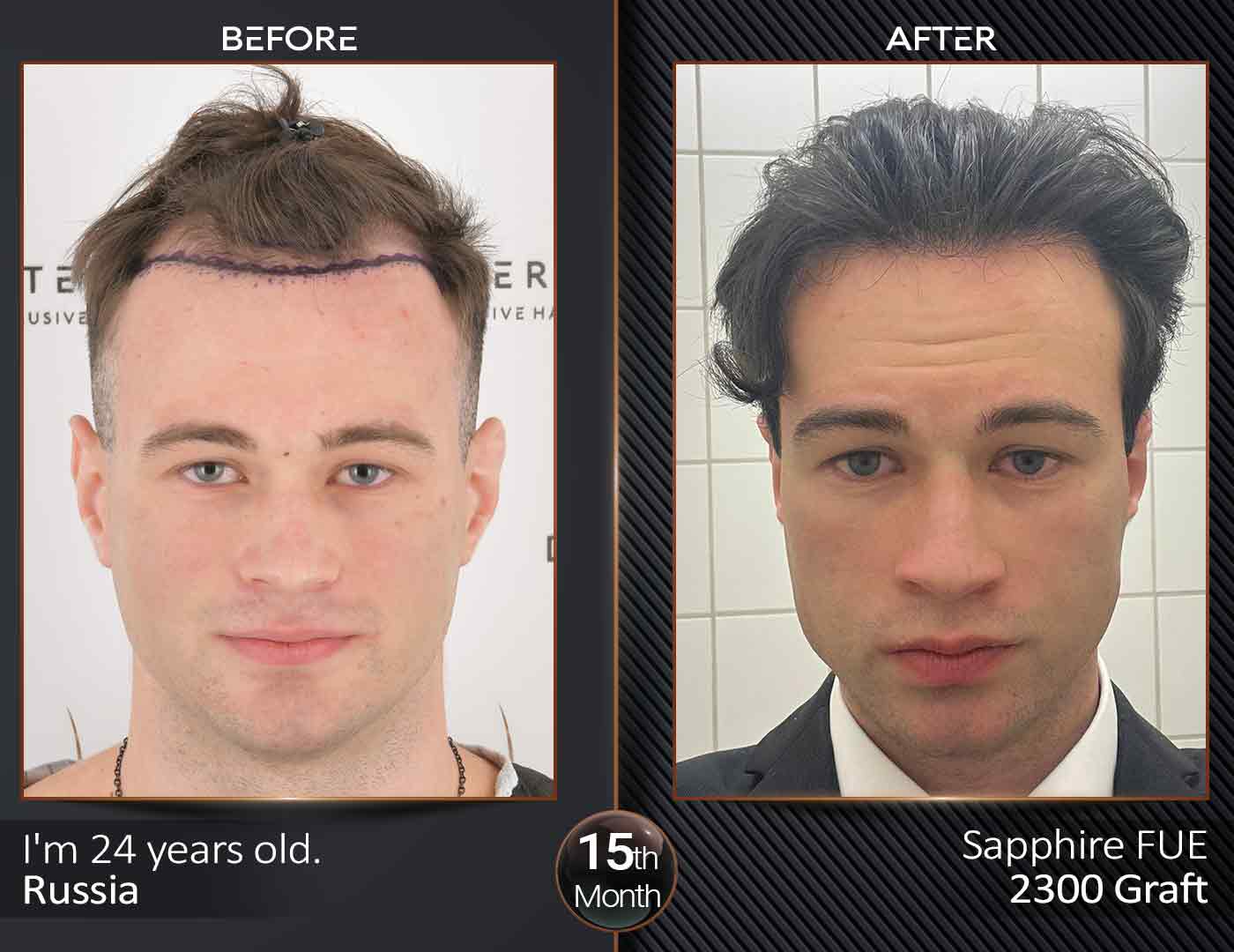 Hair Transplant Turkey: 2000 Grafts
