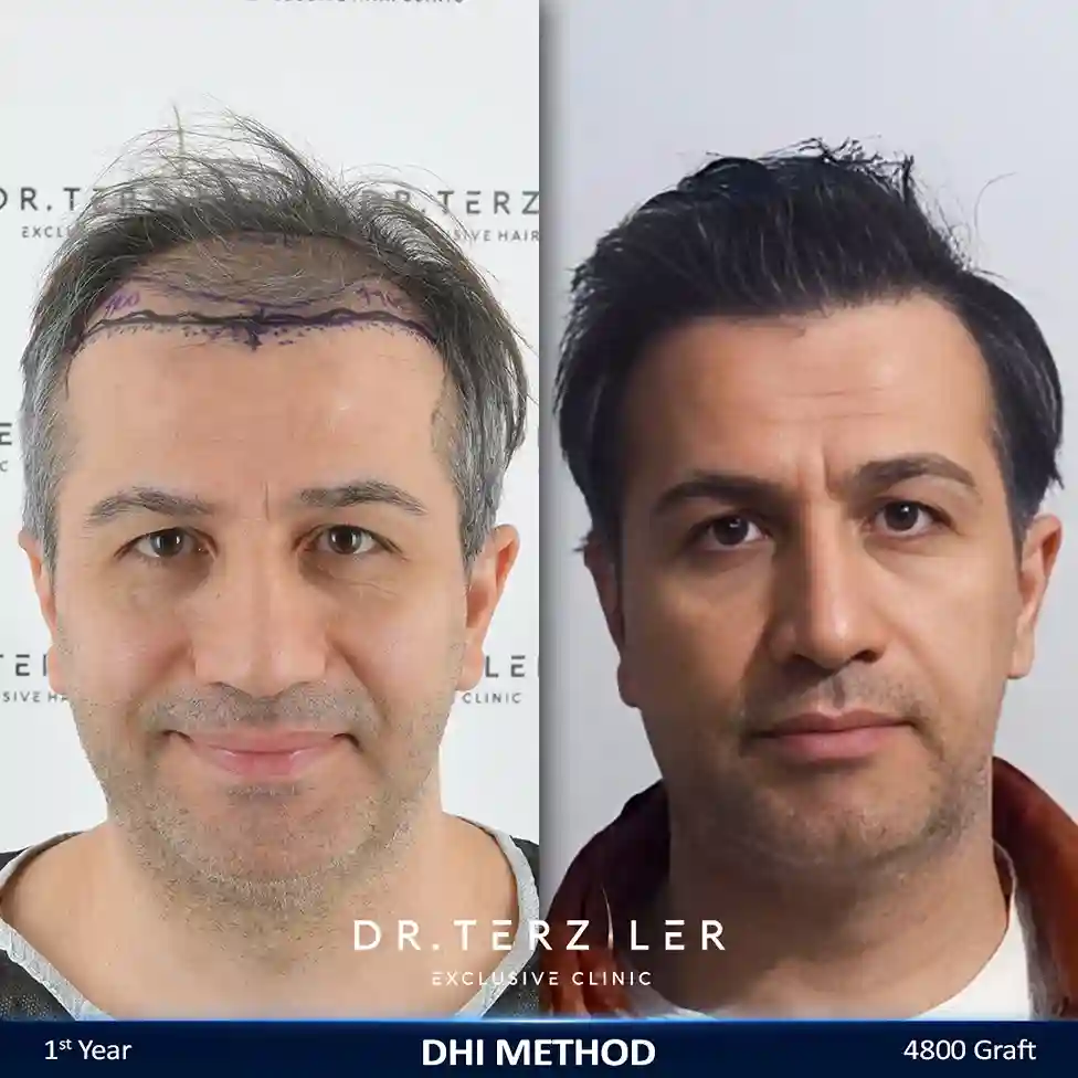 DHI Saç Ekimi Öncesi Sonrası