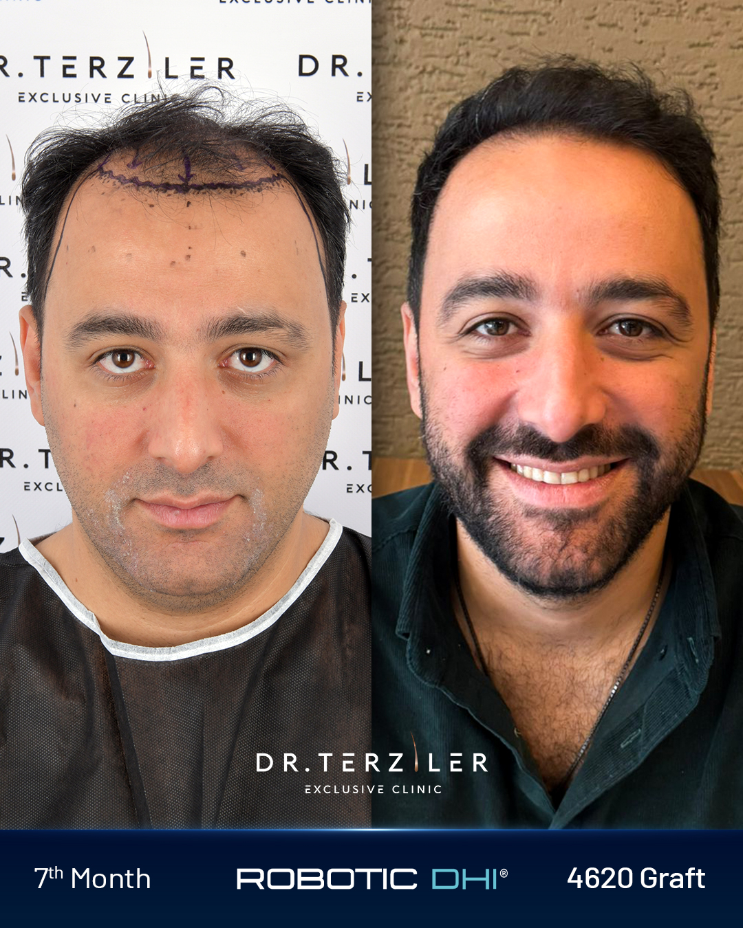 Роботизирана DHI hair transplant before and after result of patient Anıl at Dr. Terziler Exclusive Clinic in Istanbul. Frontal hairline density restored using Dr. Servet Terziler's proprietary Роботизирана DHI system.