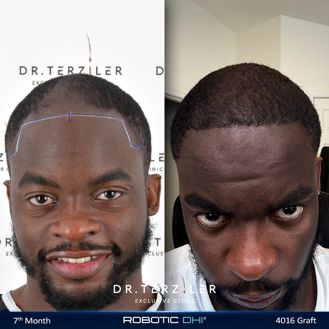 Afro Robotik DHI Saç Çizgisi Sonucu — 7. Ay, 4016 Greft, Dr. Terziler Exclusive Clinic