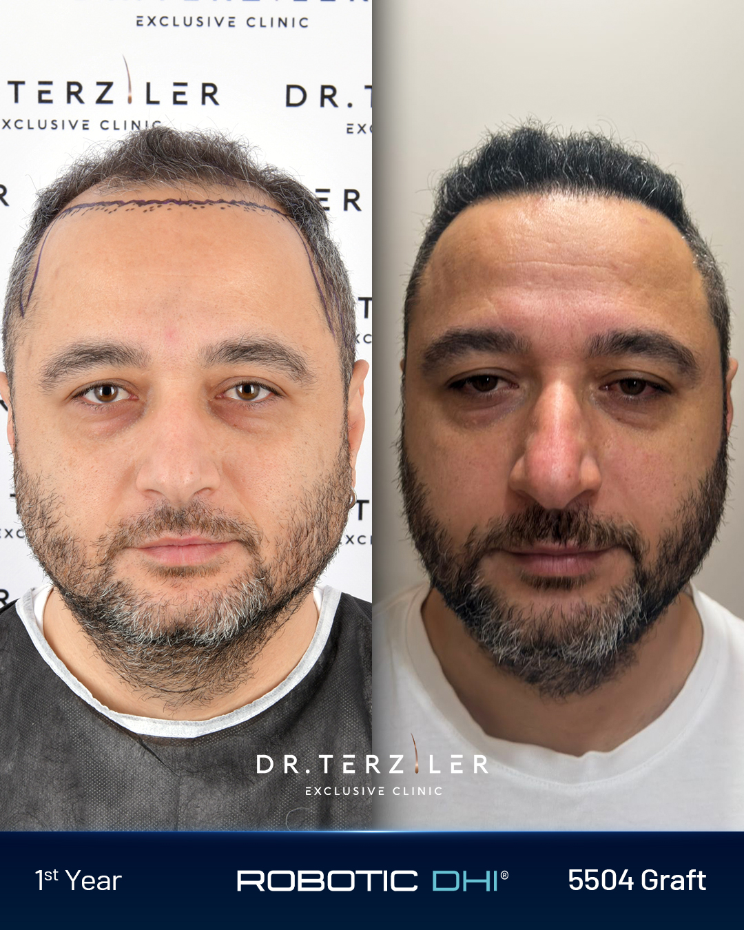 Роботизирана DHI hair transplant before and after result of patient Servettin at Dr. Terziler Exclusive Clinic in Istanbul. Crown and mid-scalp density achieved with Dr. Servet Terziler's Роботизирана DHI implantation protocol.