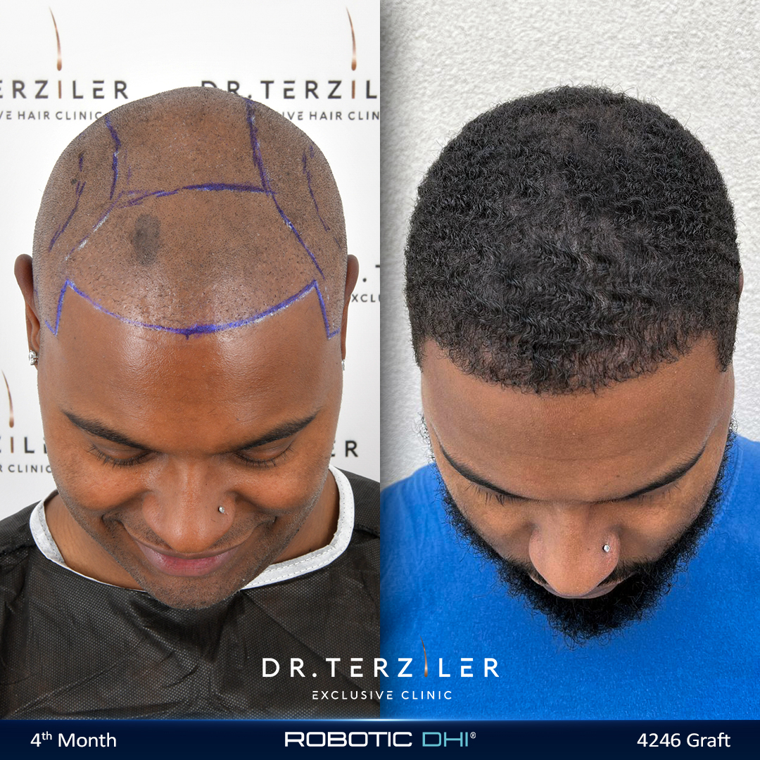 Afro Robotik DHI Önce ve Sonra — 4. Ay, 4246 Greft, Dr. Terziler Exclusive Clinic