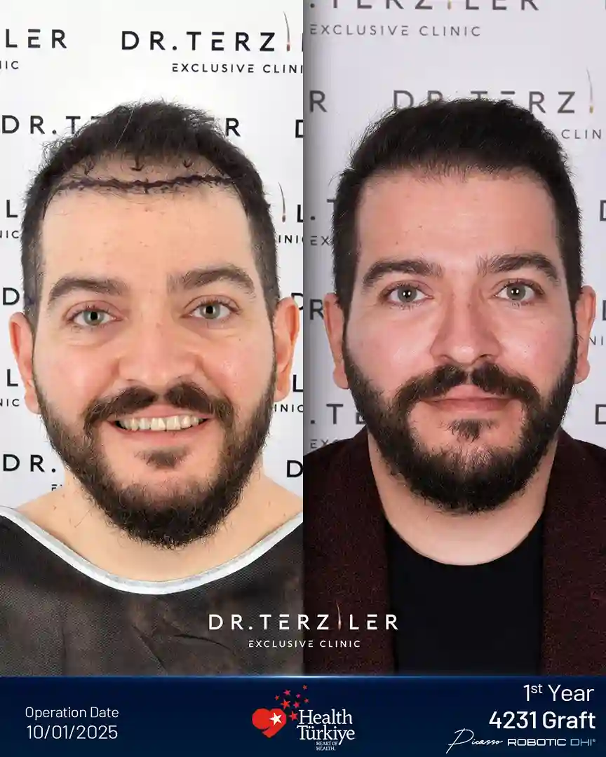 Risultato prima e dopo il trapianto di capelli Picasso Robotic DHI presso la Dr. Terziler Exclusive Clinic, Istanbul. Linea artistica dei capelli disegnata a mano dal Dr. Servet Terziler con penna Choi da 0,75 mm e macchina Robotic DHI.