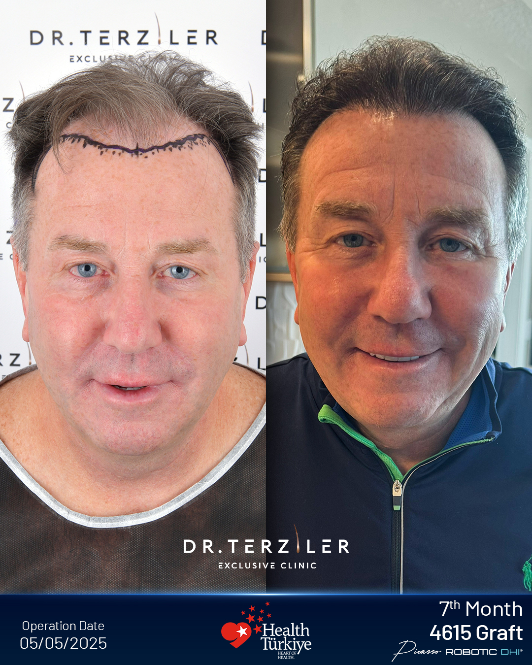 Picasso Robotic DHI Vorher-Nachher-Ergebnis. Frontotemporales Dreieck und micro-irreguläre Einzel-Transplantat-Vorderreihe entworfen von Dr. Servet Terziler in der Dr. Terziler Exclusive Clinic, Beşiktaş, Istanbul.