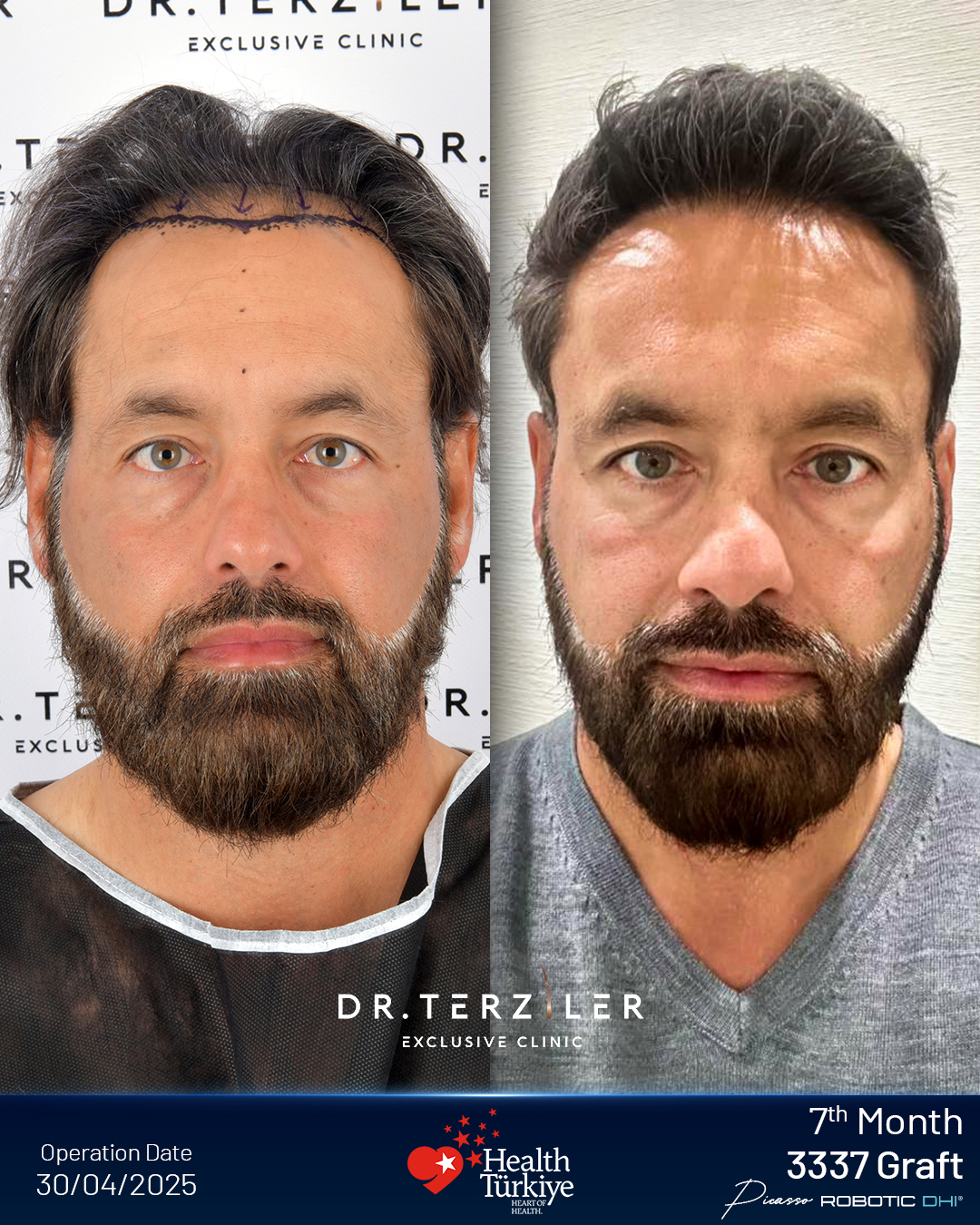 Picasso Robotic DHI Vorher-Nachher-Ergebnis. Bis zu 60 Transplantate pro cm² am Haaransatz, 35- bis 45-Grad-Angulation, 12-Monats-Ergebnis dokumentiert von Dr. Servet Terziler in der Dr. Terziler Exclusive Clinic.