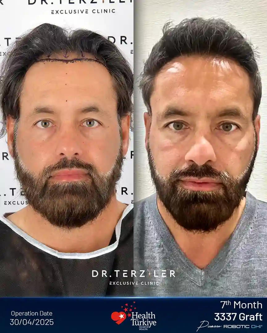 Risultato prima e dopo il Picasso Robotic DHI. Fino a 60 graft per cm² alla linea dei capelli, angolazione da 35 a 45 gradi, risultato a 12 mesi documentato dal Dr. Servet Terziler presso la Dr. Terziler Exclusive Clinic.