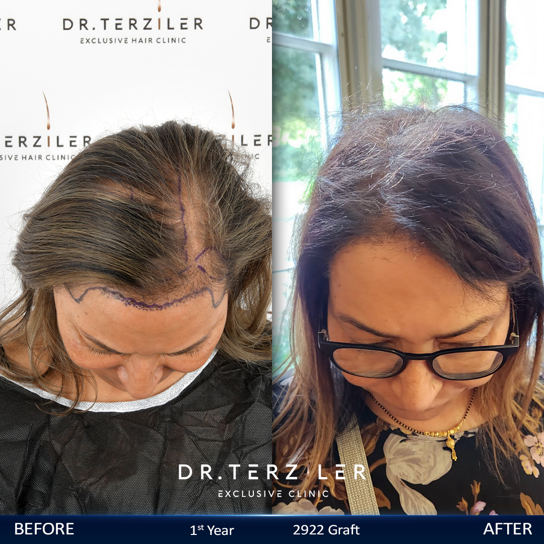 Vorher-Nachher Haartransplantation für Frauen — Dr. Terziler Clinic