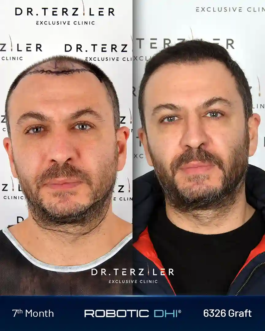 Risultato prima-dopo del trapianto di capelli Robotic DHI del paziente Salih Ağaoğlu presso la Dr. Terziler Exclusive Clinic a Istanbul. Restauro della linea frontale documentato dal Dr. Servet Terziler con la macchina Robotic DHI proprietaria.