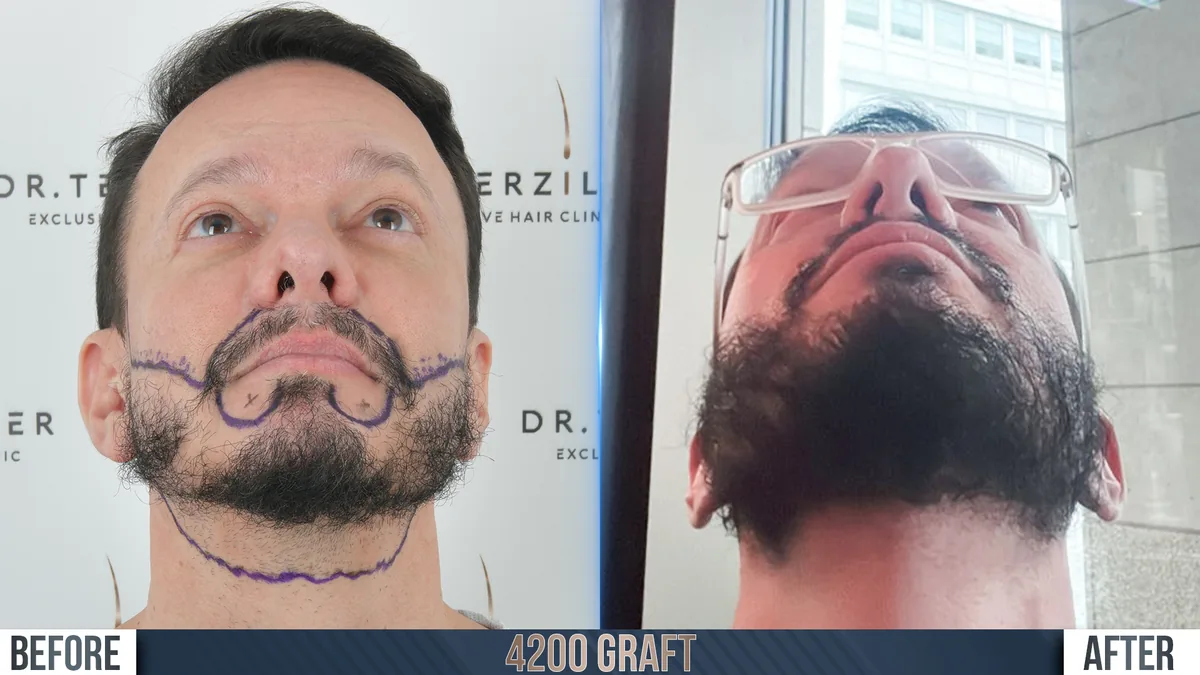 Beard and mustache transplant before and after front angle at Dr. Terziler Exclusive Clinic