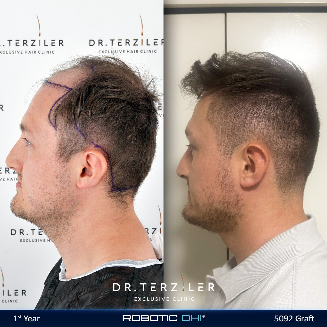 Trapianto di capelli Connor prima-dopo