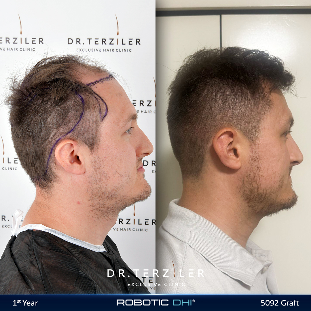 Densità finale trapianto di capelli Connor