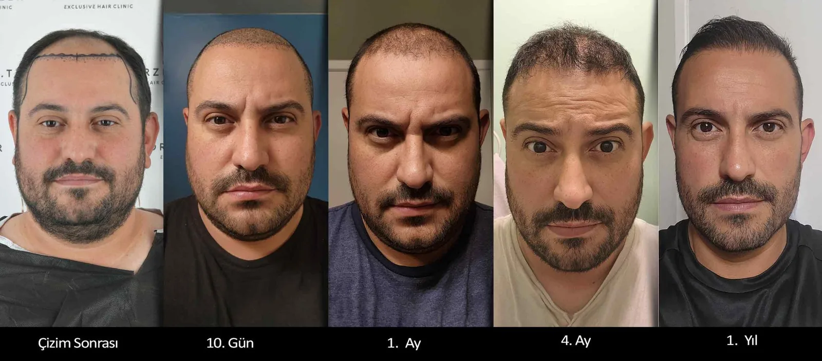 Safir FUE saç ekimi öncesi ve sonrası zaman çizelgesi — Dr. Terziler Exclusive Clinic İstanbul, 1 ila 6. aylar