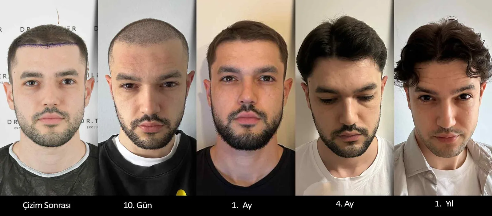 Safir FUE saç ekimi öncesi ve sonrası zaman çizelgesi — Dr. Terziler Exclusive Clinic İstanbul, 6 ila 12. aylar