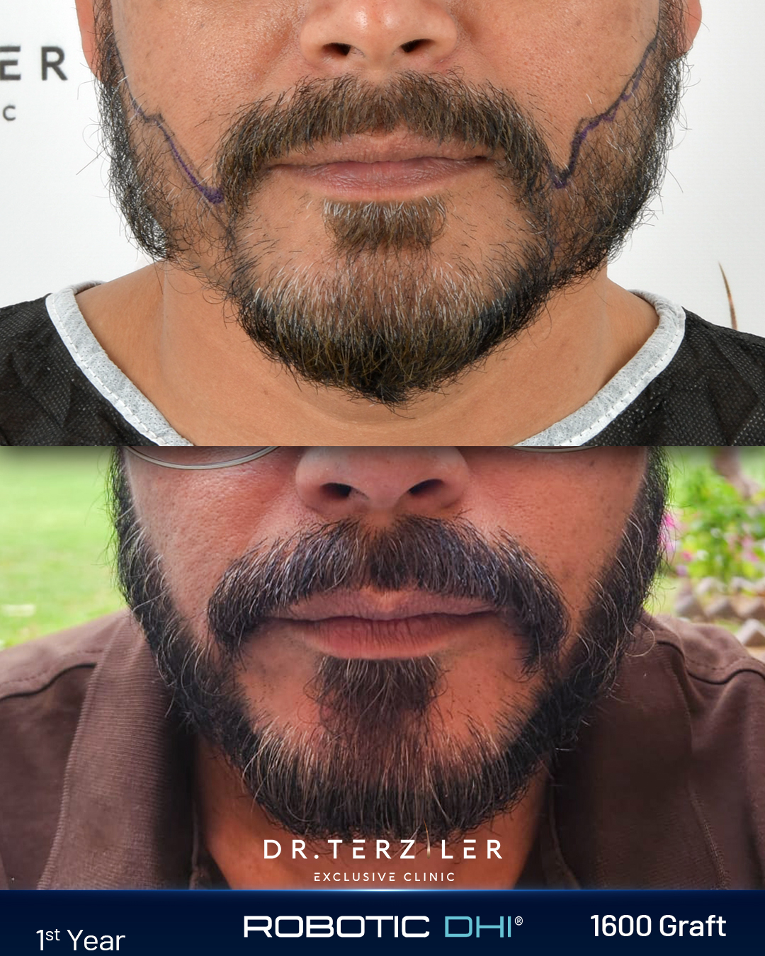 Beard transplant before after case by Dr. Terziler Exclusive Clinic