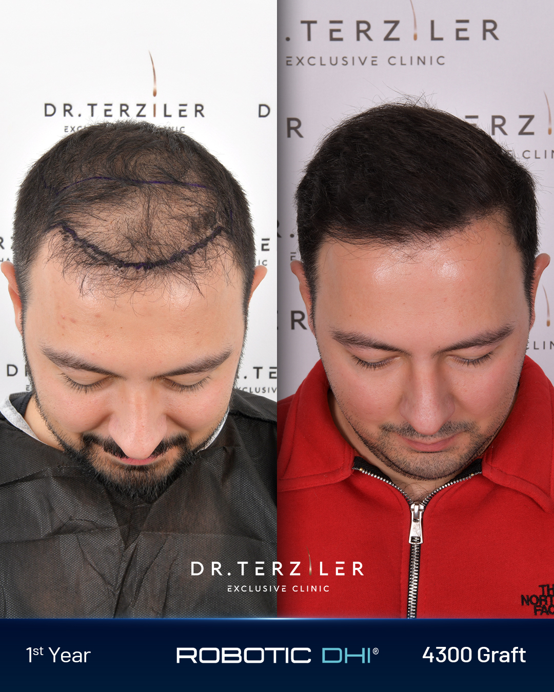 4000 greft saç ekimi 9-12 ay sonucu Dr. Terziler