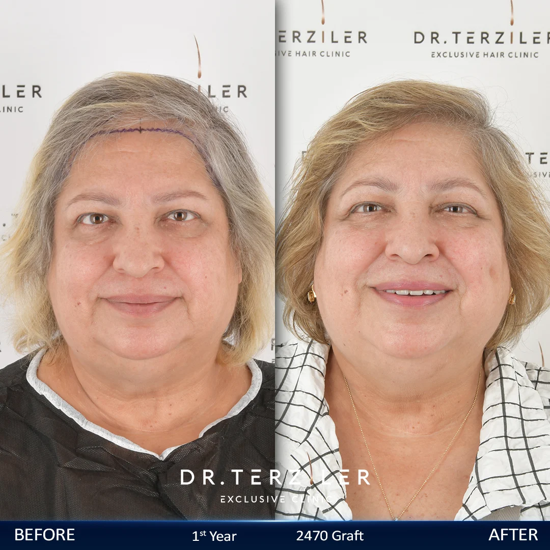 2400 graft hair transplant patient before after at the leading hair transplant clinic in Turkey Dr. Terziler