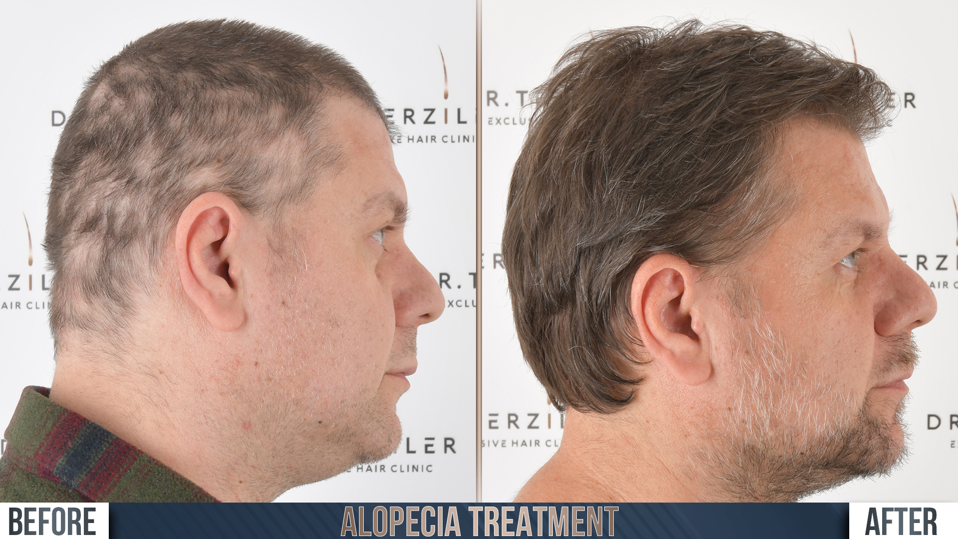 Alopecia hair transplant before and after results, Patient 1, Month 12 ‚Äî Dr. Terziler Istanbul