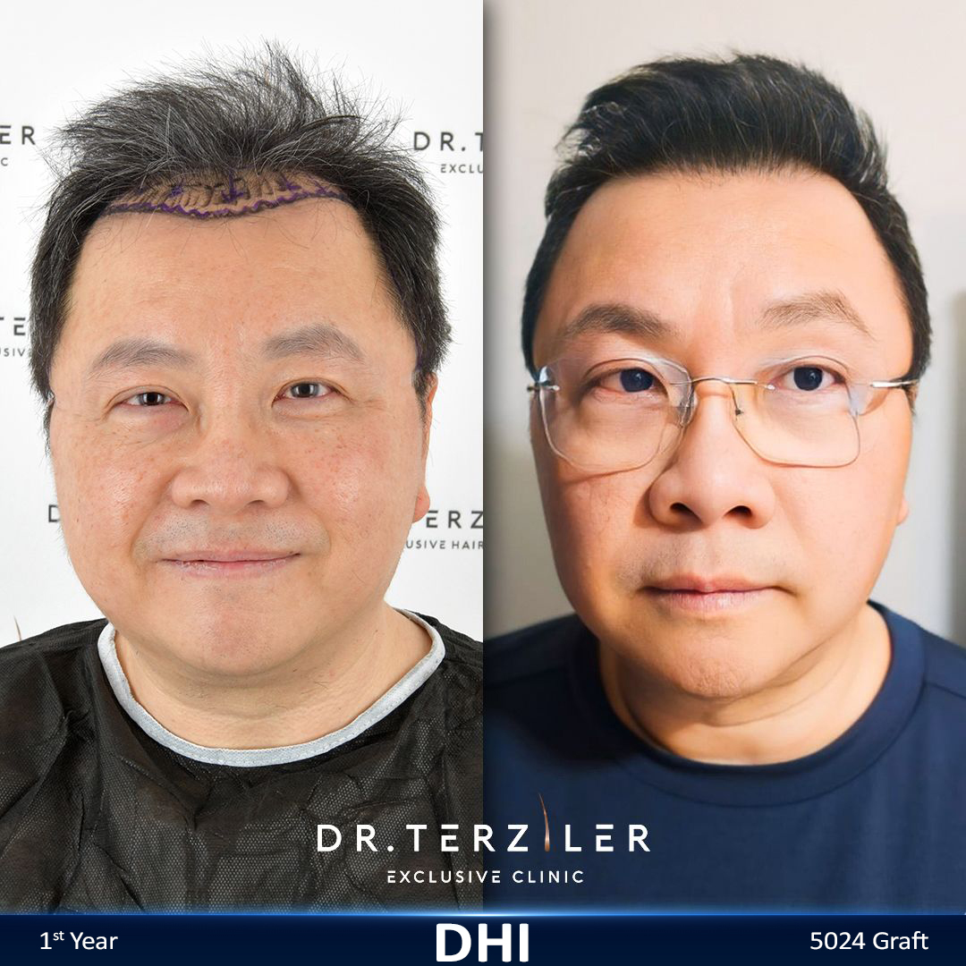 DHI hair transplant before and after results, Patient 1 front view, Month 12 ‚Äî Dr. Terziler Istanbul