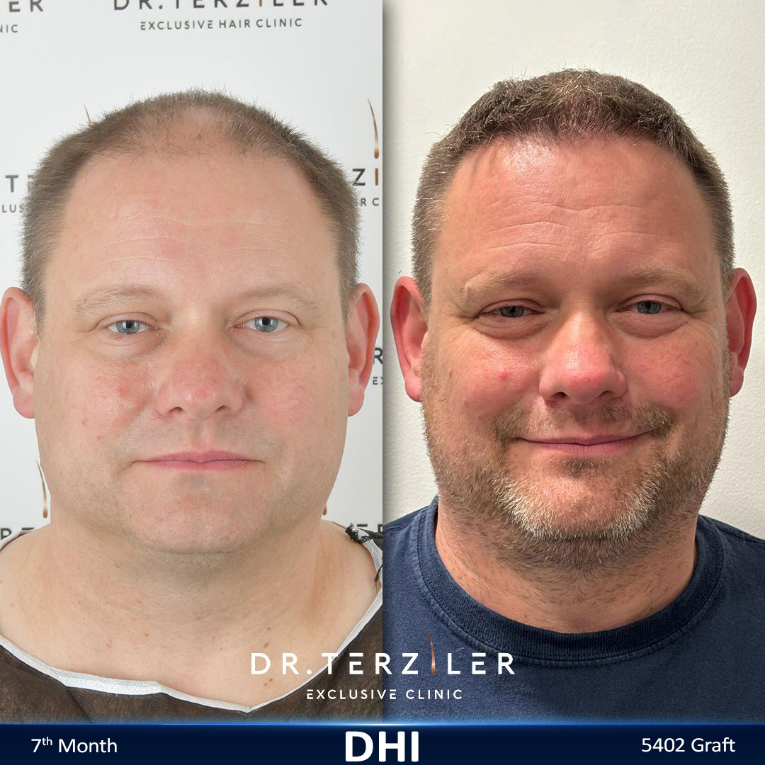 DHI hair transplant before and after results, Patient 2 front view, Month 12 ‚Äî Dr. Terziler Istanbul