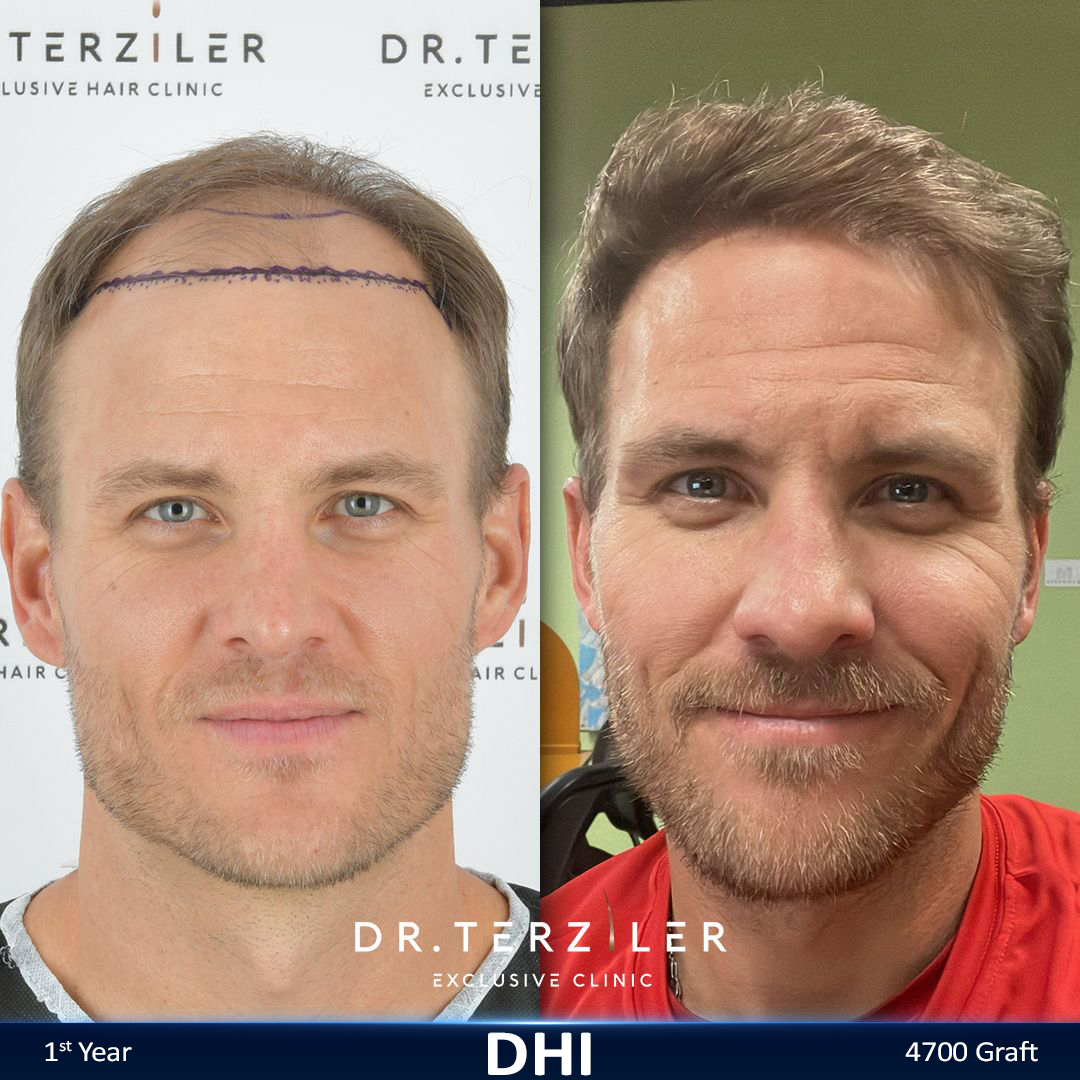 DHI hair transplant before and after results, Patient 3 front view, Month 12 ‚Äî Dr. Terziler Istanbul