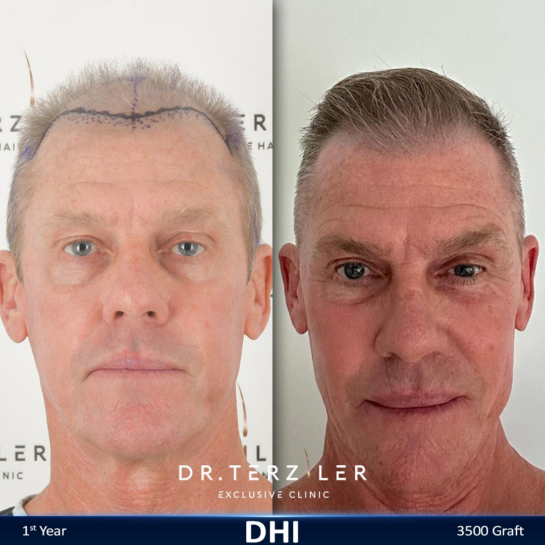 DHI hair transplant before and after results, Patient 4 front view, Month 12 ‚Äî Dr. Terziler Istanbul