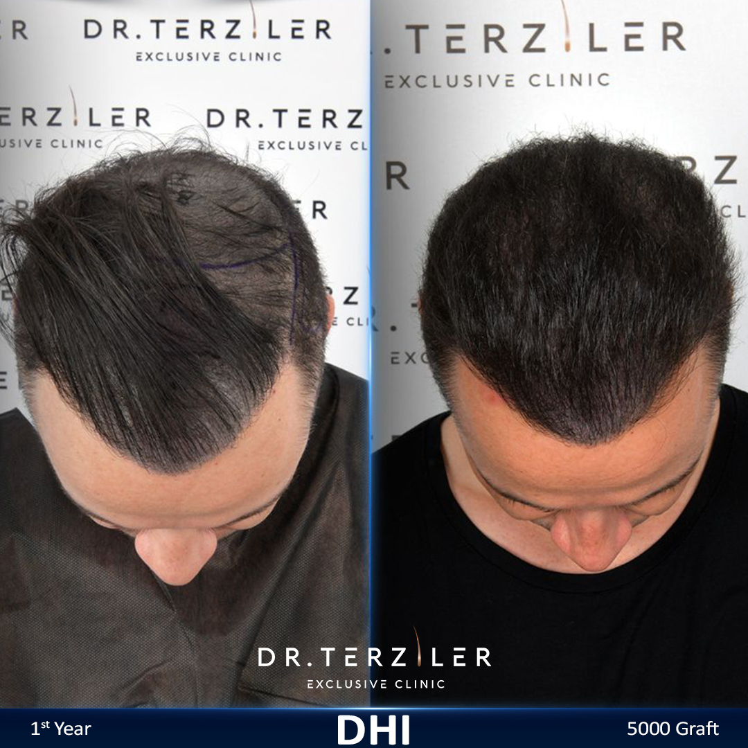 DHI hair transplant before and after results, Patient 5 front view, Month 12 ‚Äî Dr. Terziler Istanbul