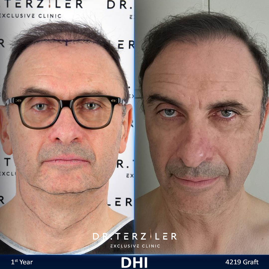DHI hair transplant before and after results, Patient 6 front view, Month 12 ‚Äî Dr. Terziler Istanbul