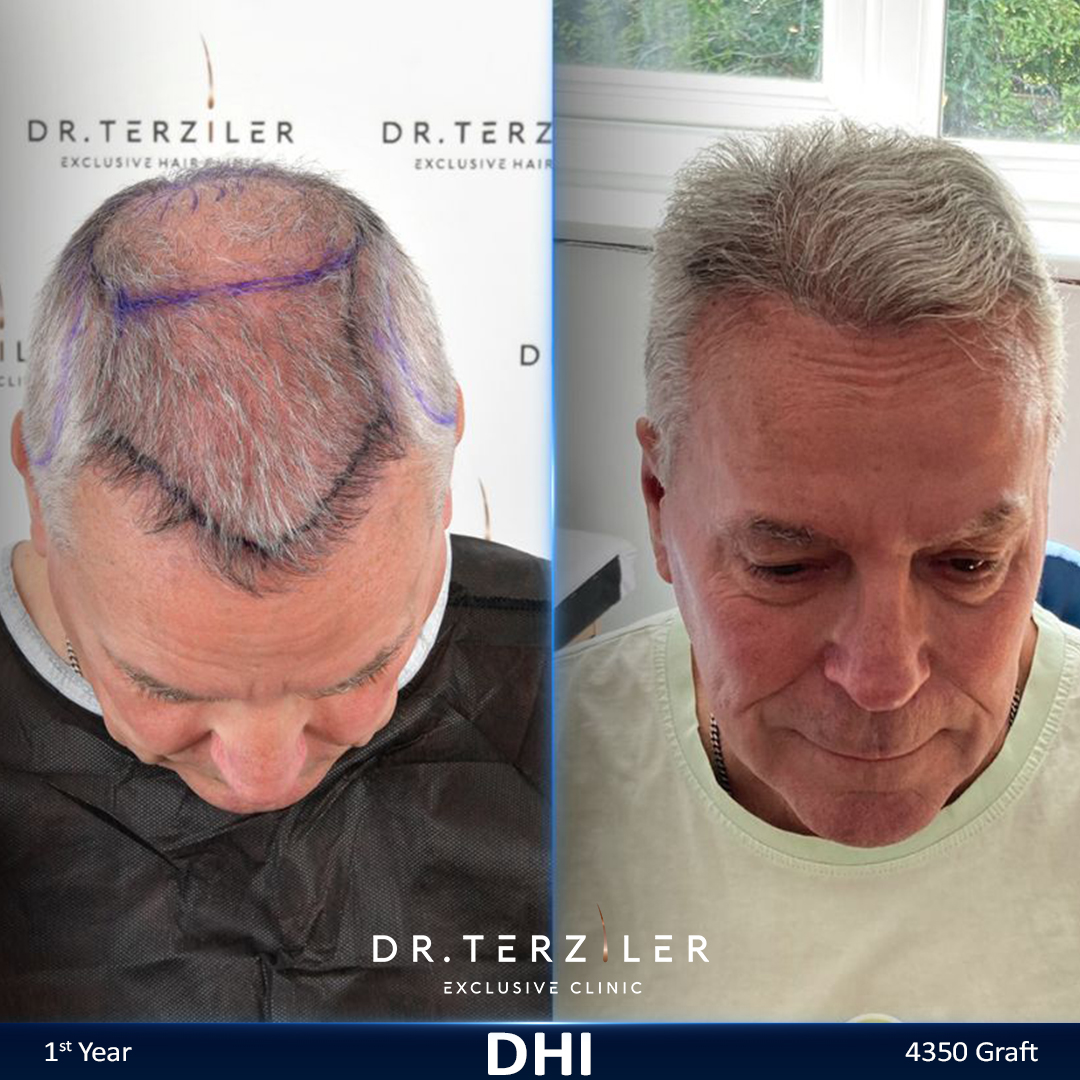 DHI hair transplant before and after results, Patient 7 front view, Month 12 ‚Äî Dr. Terziler Istanbul