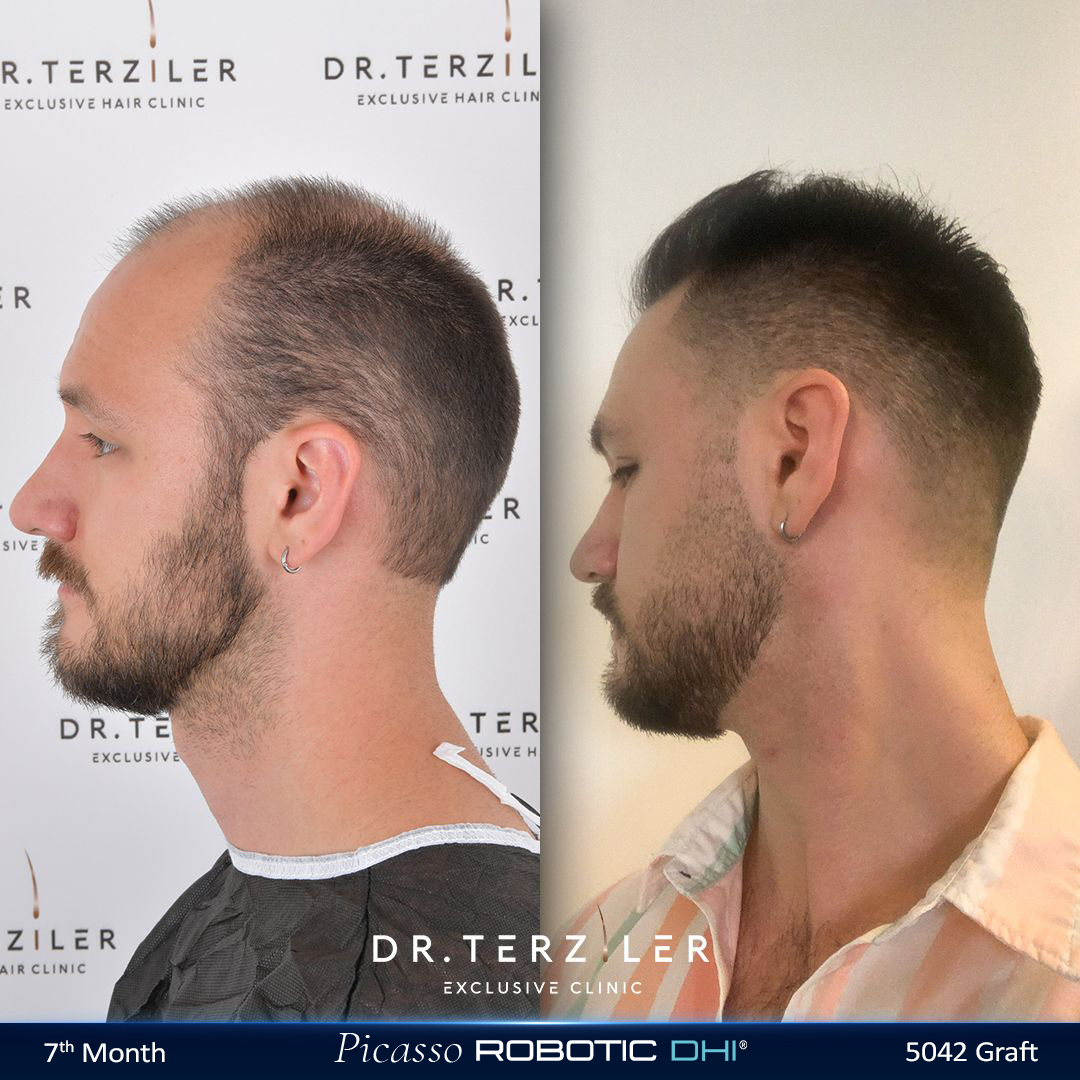 Picasso Robotic DHI hair transplant before and after results, Patient 1 right side view, Month 12 ‚Äî Dr. Terziler Istanbul