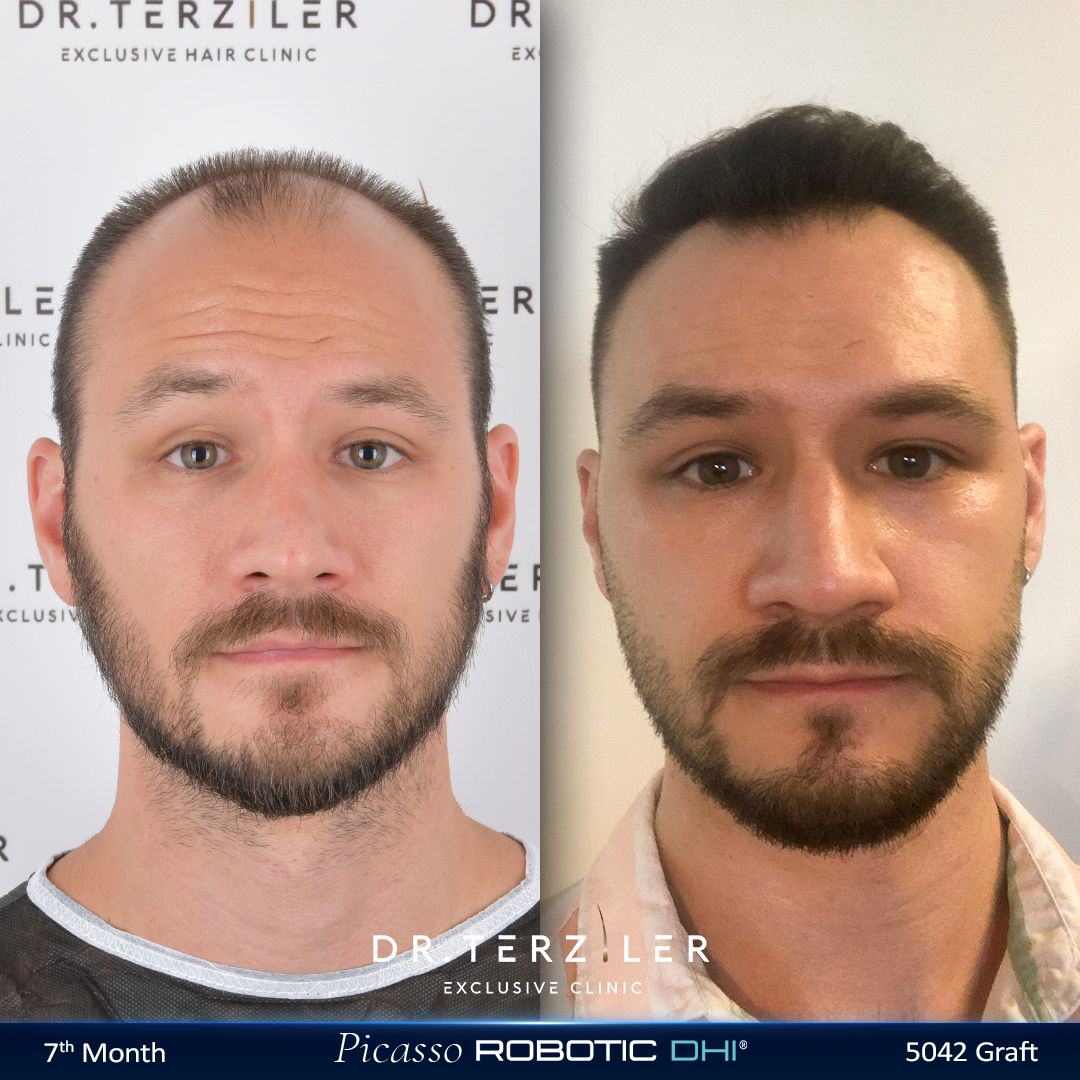 Picasso Robotic DHI hair transplant before and after results, Patient 1 front view, Month 12 ‚Äî Dr. Terziler Istanbul