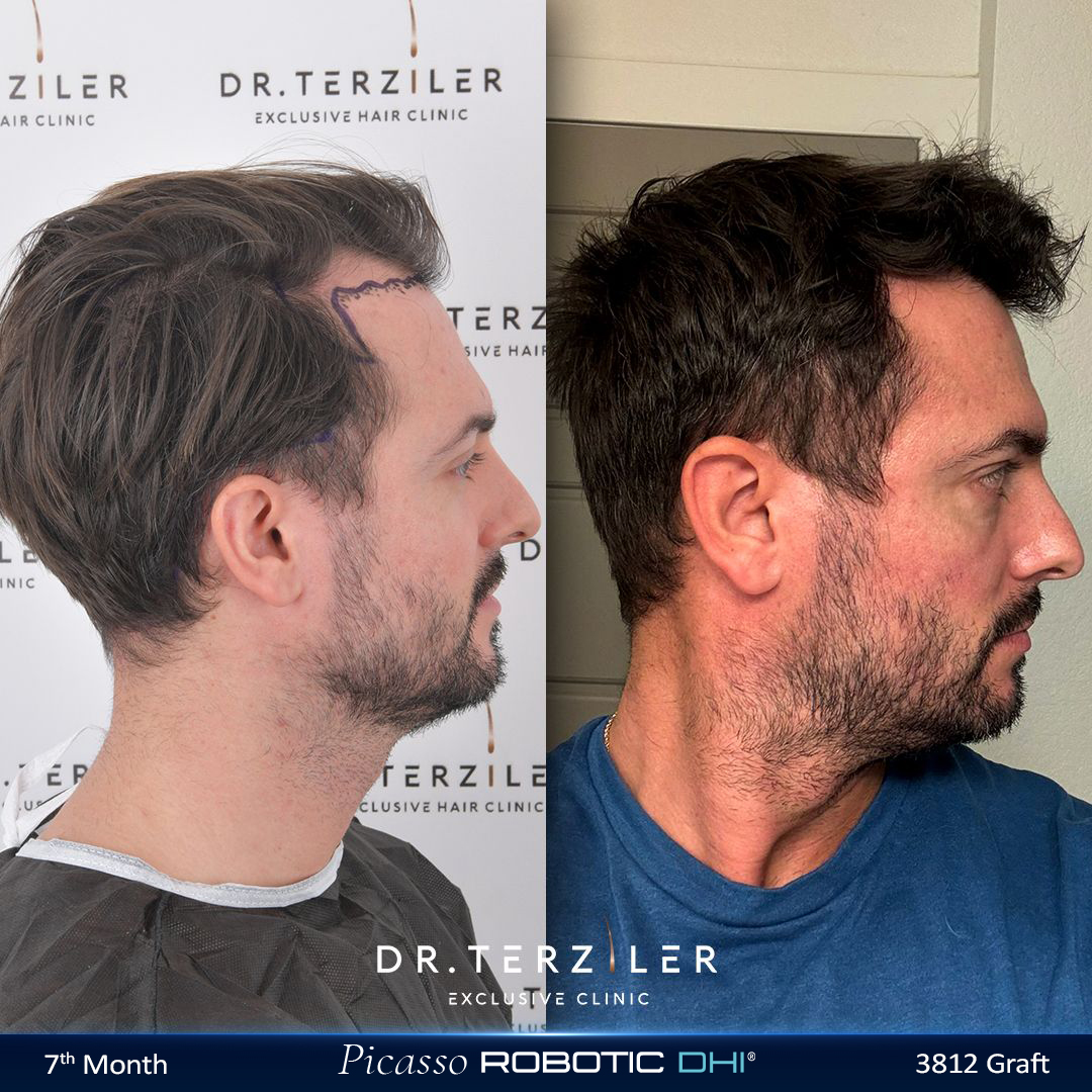 Picasso Robotic DHI hair transplant before and after results, Patient 2 left side view, Month 12 ‚Äî Dr. Terziler Istanbul