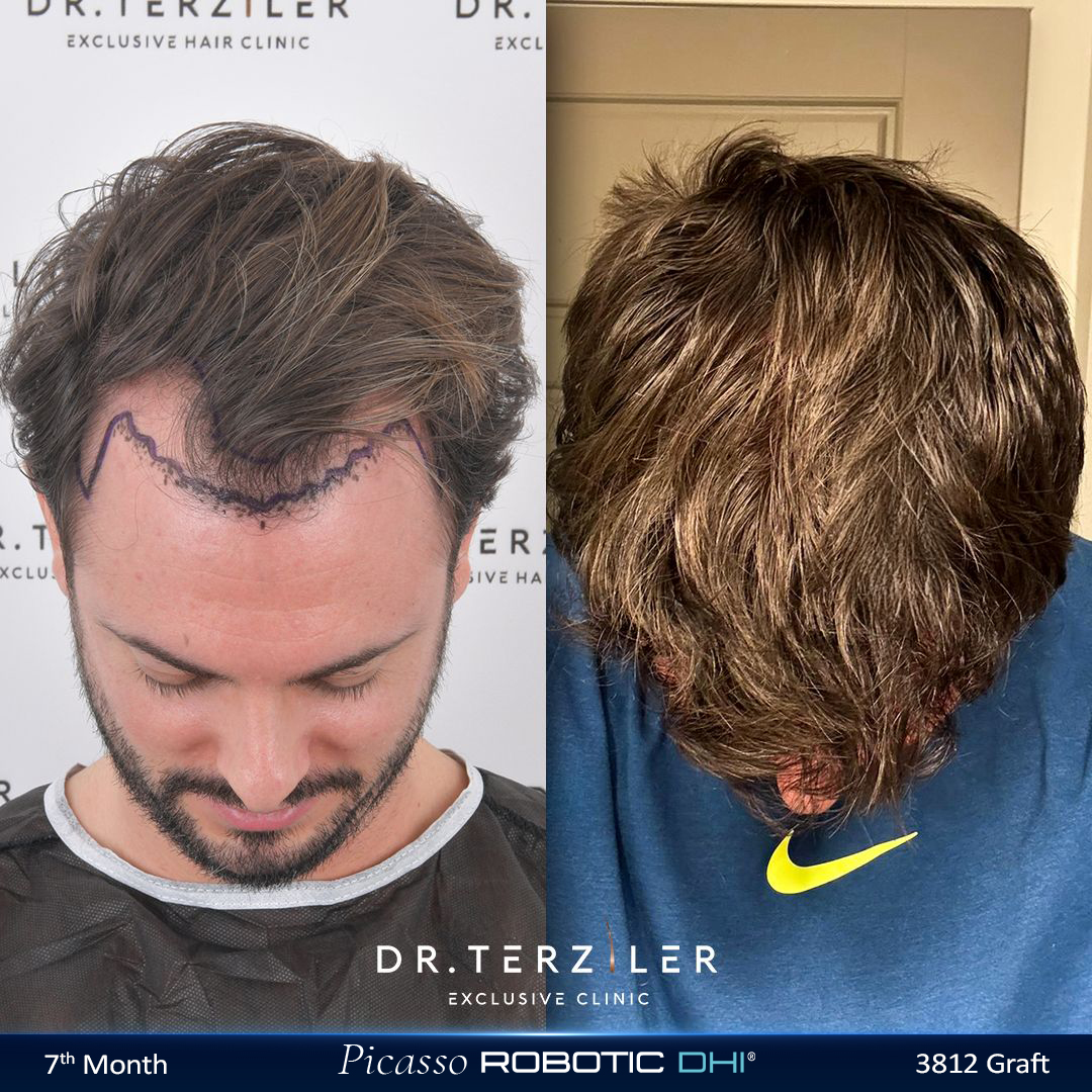 Picasso Robotic DHI hair transplant before and after results, Patient 2 top/crown view, Month 12 ‚Äî Dr. Terziler Istanbul