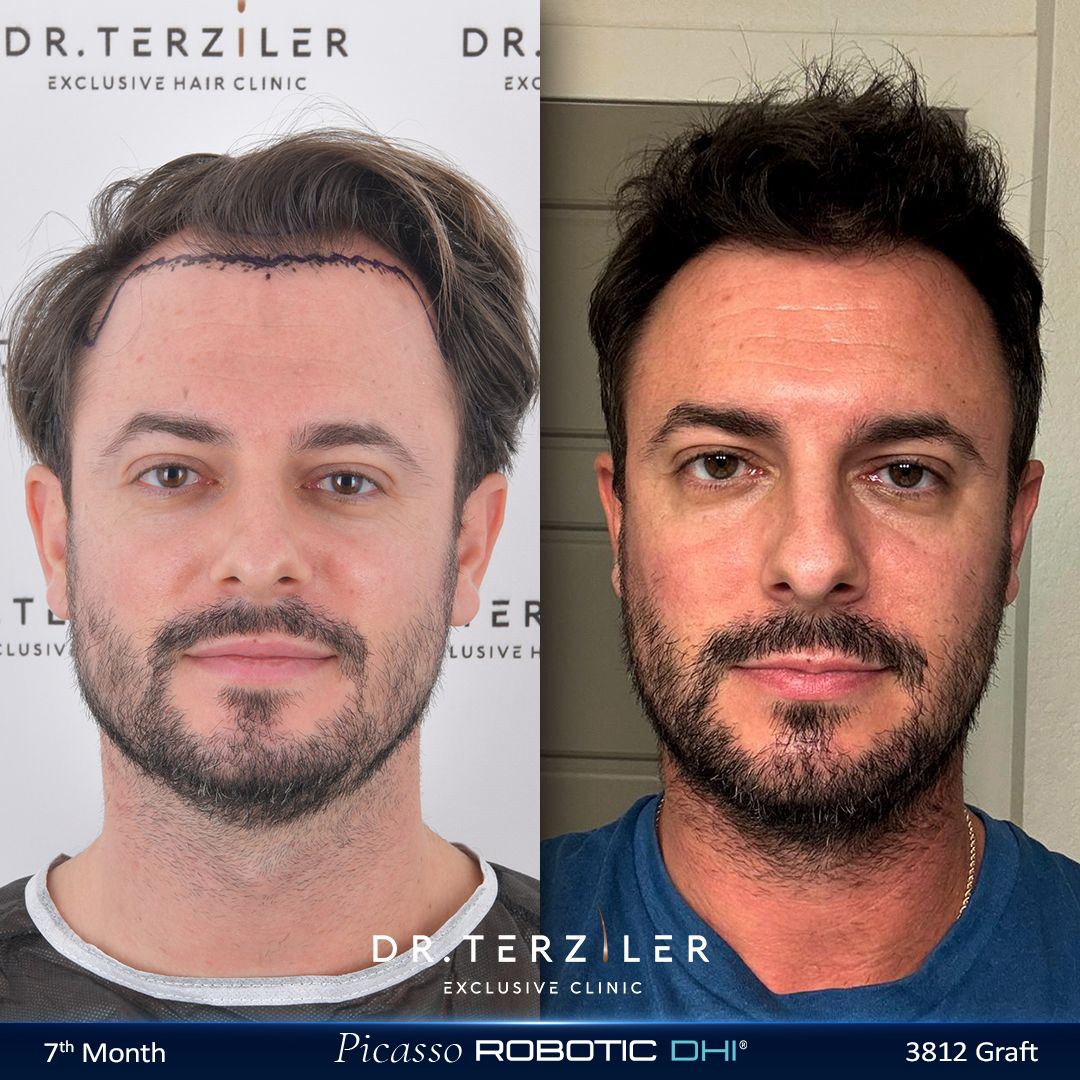 Picasso Robotic DHI hair transplant before and after results, Patient 2 front view, Month 12 ‚Äî Dr. Terziler Istanbul