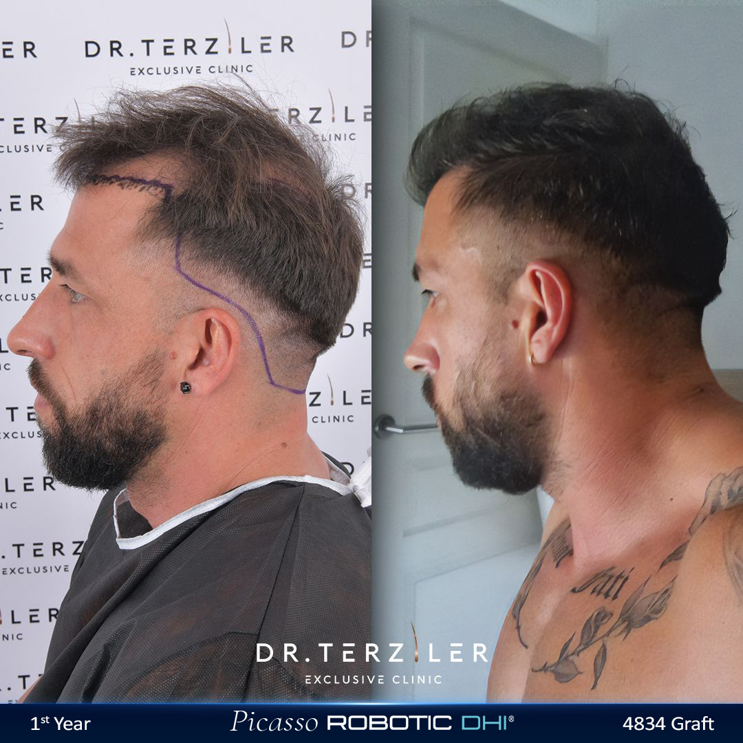 Picasso Robotic DHI hair transplant before and after results, Patient 3 right side view, Month 12 ‚Äî Dr. Terziler Istanbul