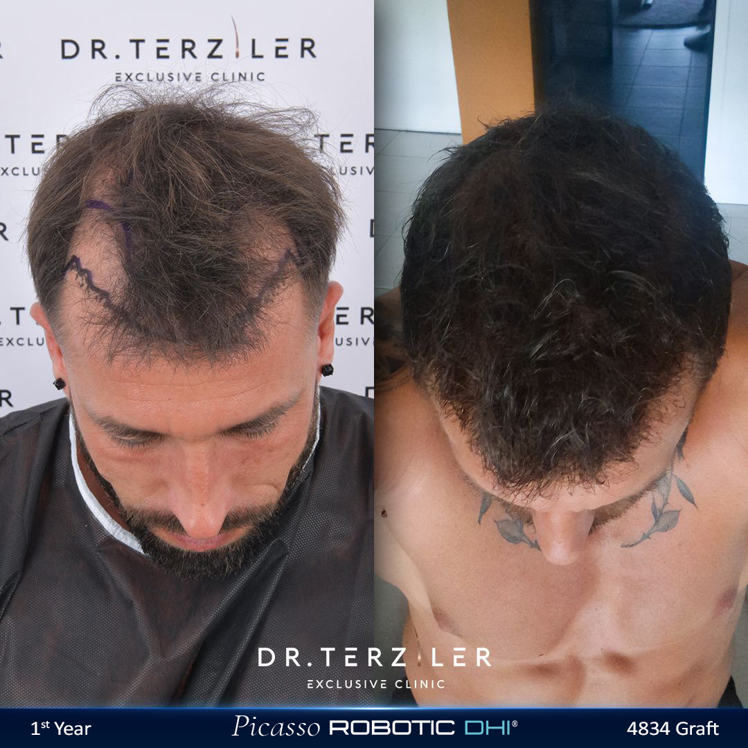 Picasso Robotic DHI hair transplant before and after results, Patient 3 top/crown view, Month 12 ‚Äî Dr. Terziler Istanbul