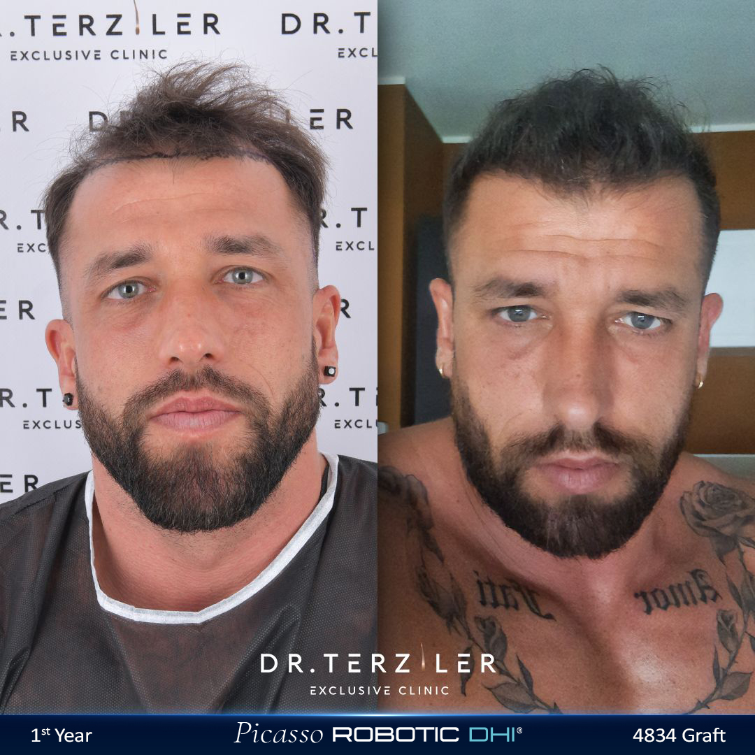 Picasso Robotic DHI hair transplant before and after results, Patient 3 front view, Month 12 ‚Äî Dr. Terziler Istanbul