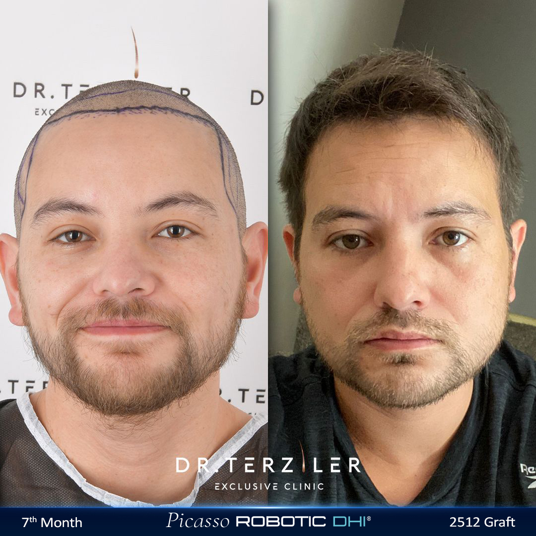 Picasso Robotic DHI hair transplant before and after results, Patient 4 front view, Month 12 ‚Äî Dr. Terziler Istanbul