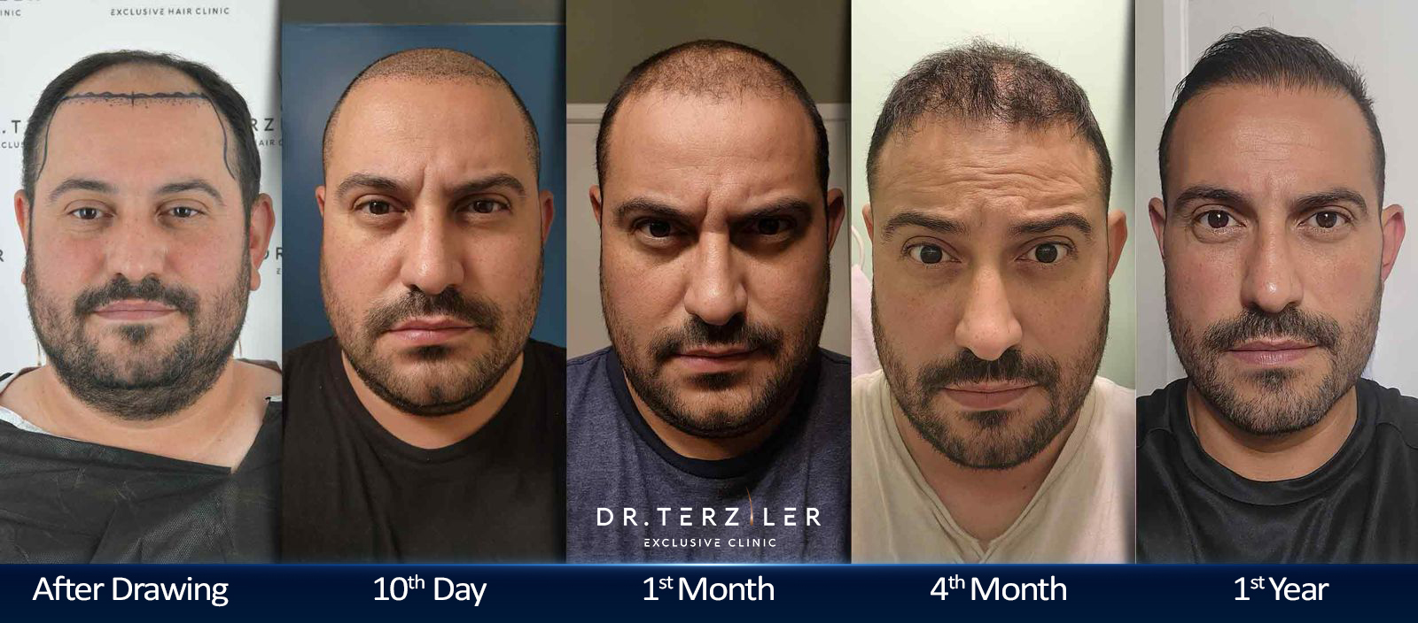Hair transplant before and after results month by month, Day 0 to Month 12 timeline ‚Äî Patient A, Dr. Terziler Istanbul