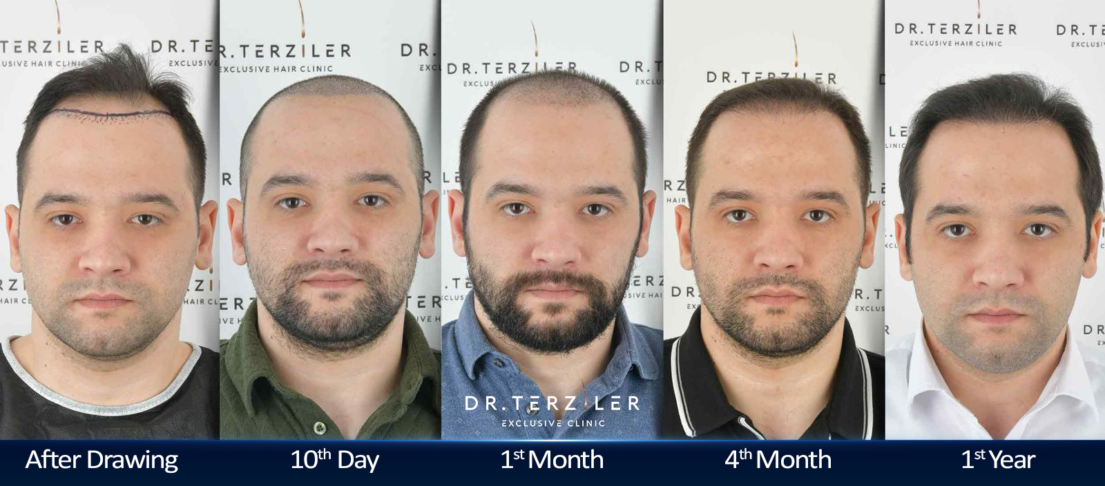 Hair transplant before and after results month by month, Day 0 to Month 12 timeline ‚Äî Patient B, Dr. Terziler Istanbul