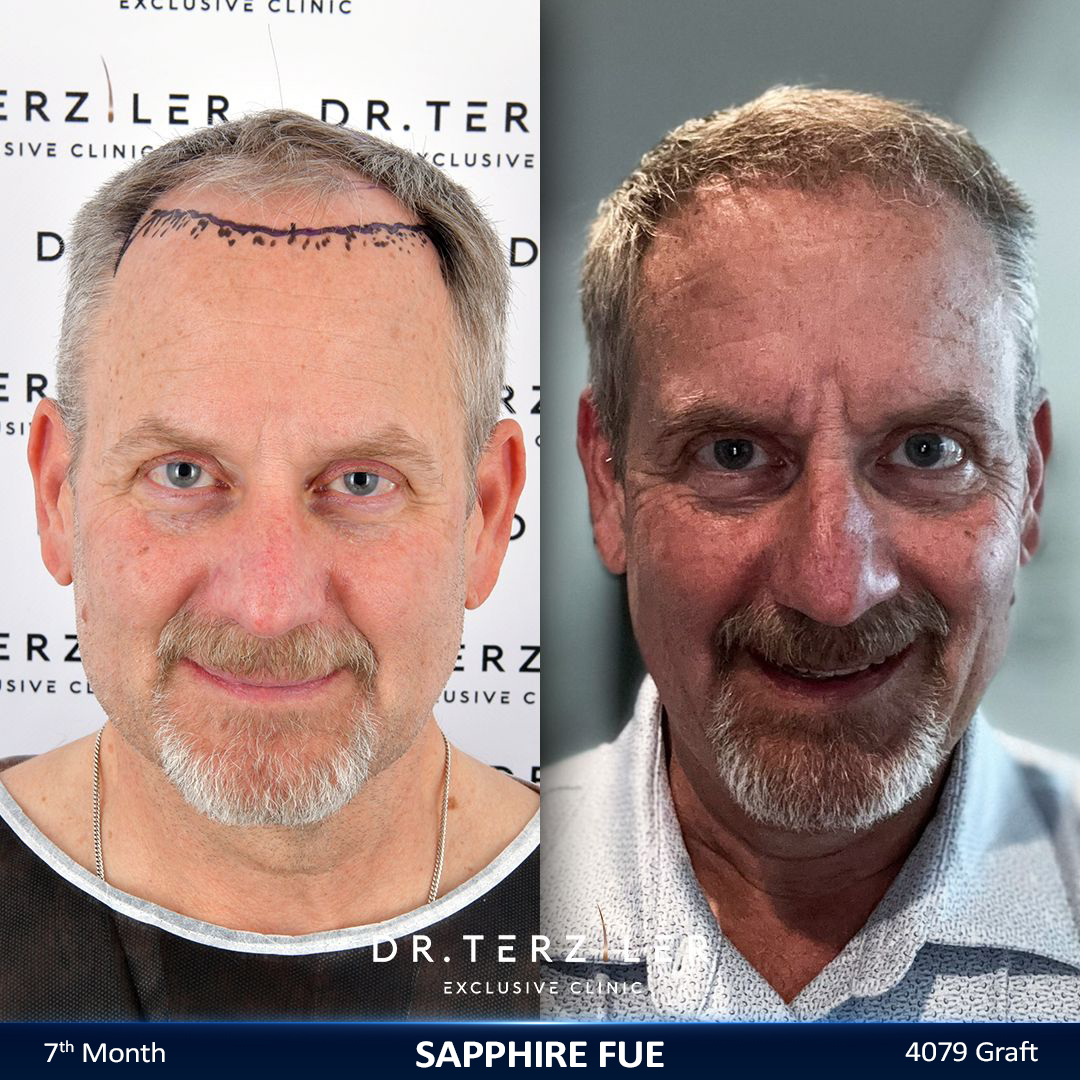 Sapphire FUE hair transplant before and after results, Patient 1 front view, Month 12 ‚Äî Dr. Terziler Istanbul