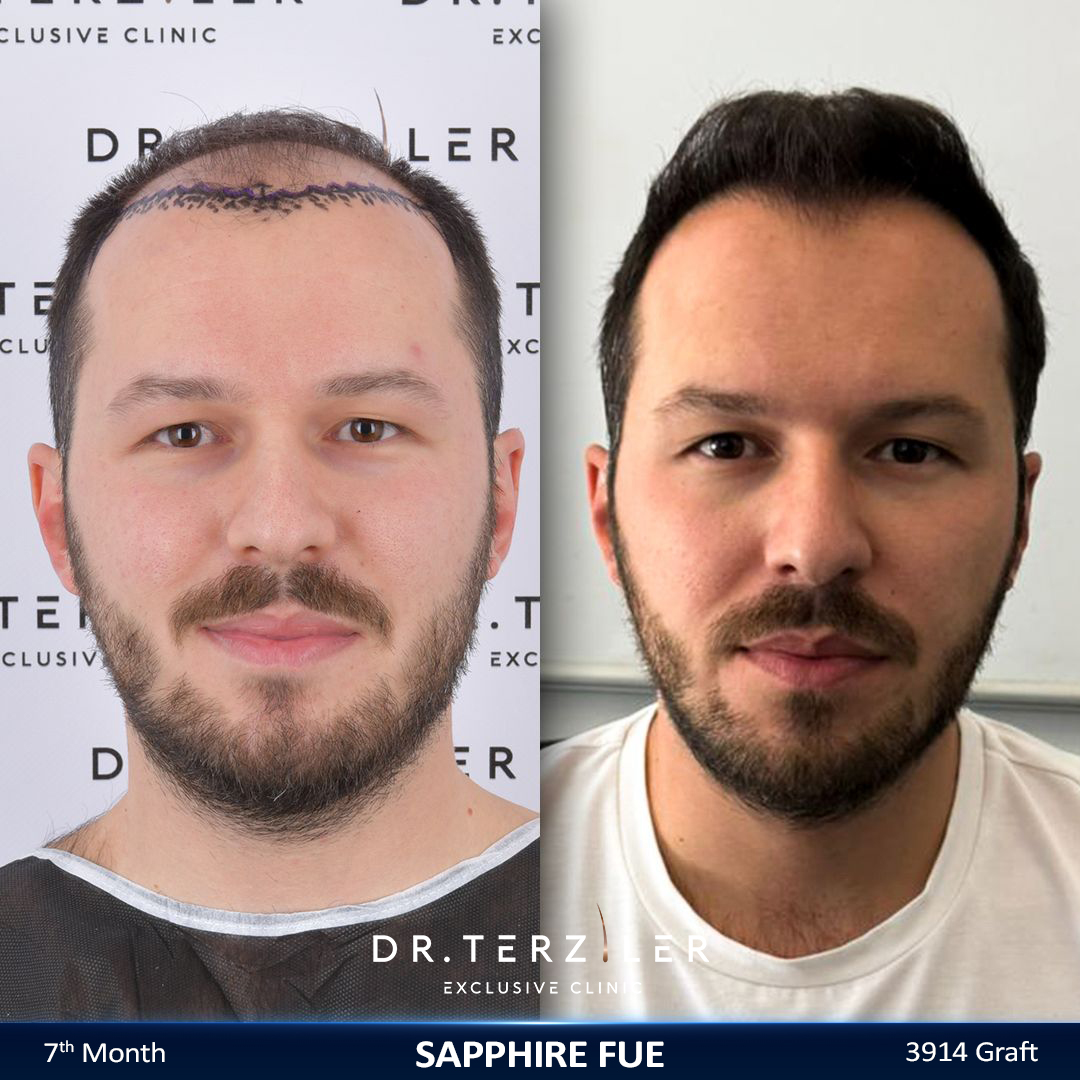 Sapphire FUE hair transplant before and after results, Patient 2 front view, Month 12 ‚Äî Dr. Terziler Istanbul