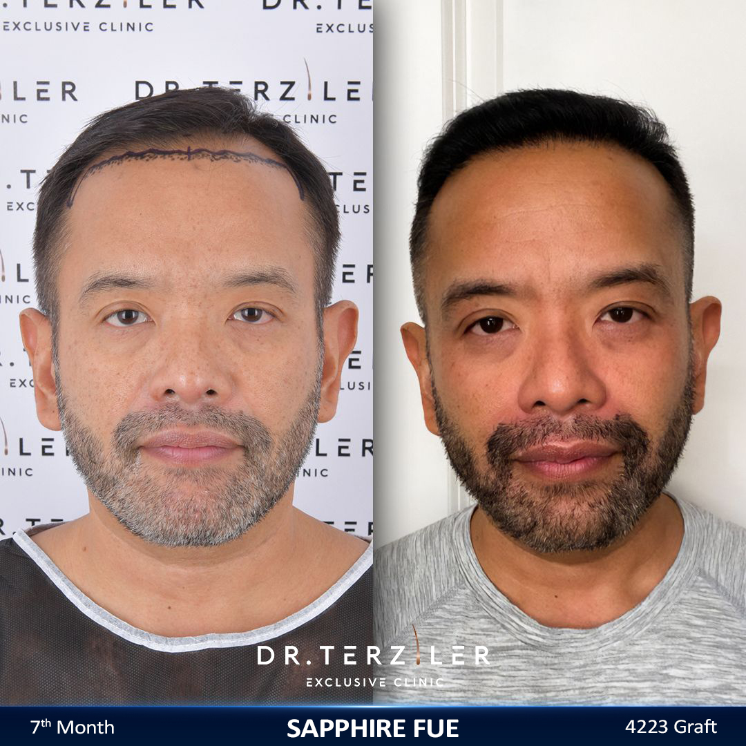 Sapphire FUE hair transplant before and after results, Patient 3 front view, Month 12 ‚Äî Dr. Terziler Istanbul