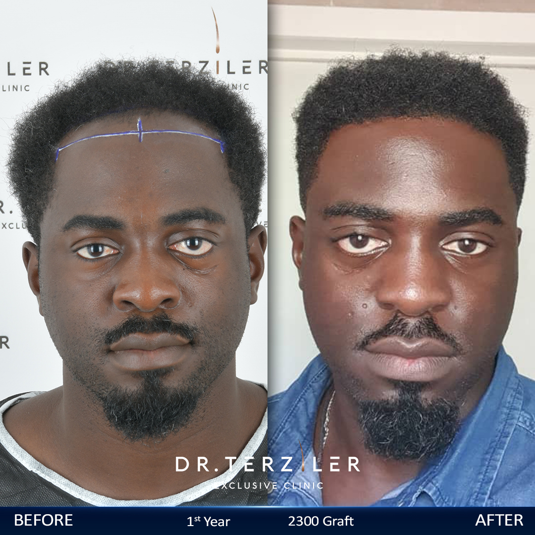 Afro hair transplant before and after results, Patient 1, Month 12 ‚Äî Dr. Terziler Istanbul