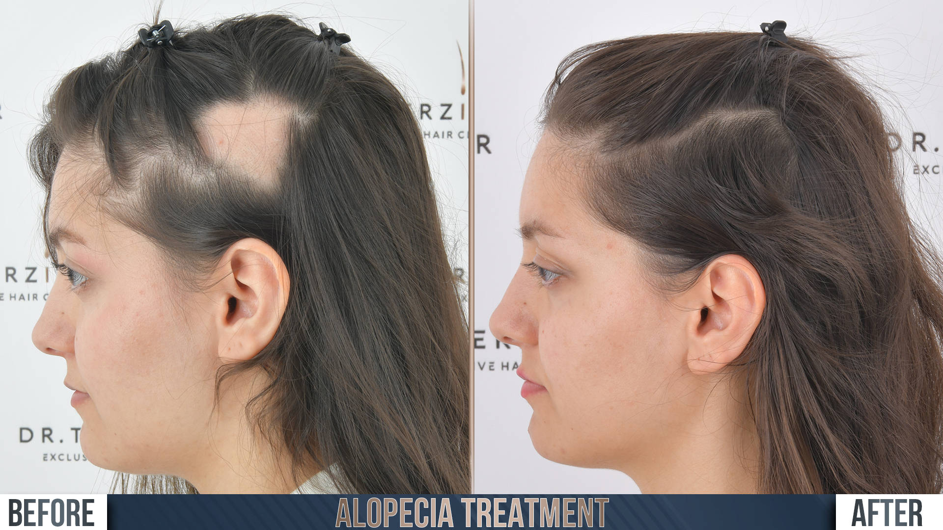 Alopecia hair transplant before and after results, Patient 2, Month 12 ‚Äî Dr. Terziler Istanbul