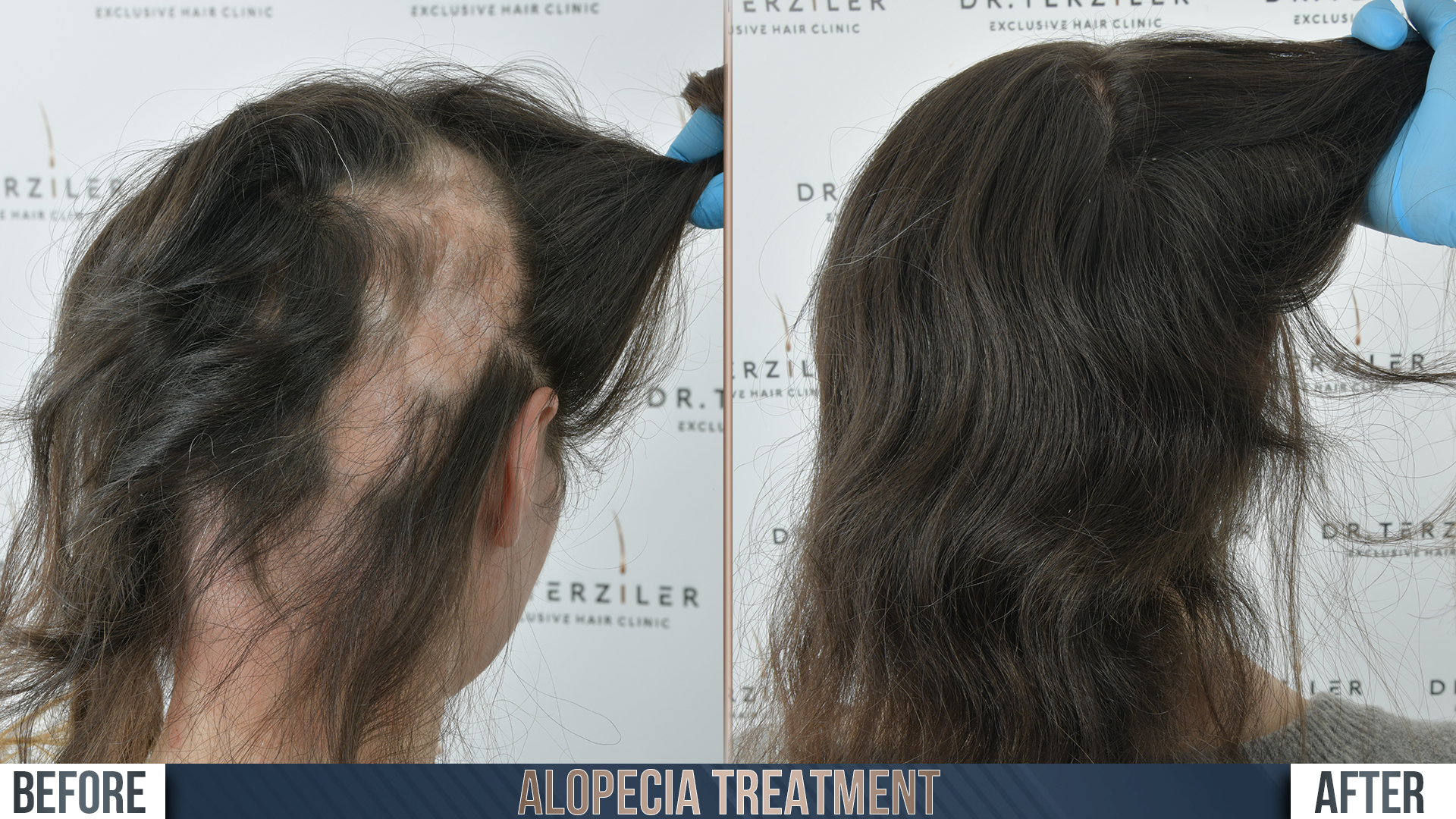 Alopecia hair transplant before and after results, Patient 3, Month 12 ‚Äî Dr. Terziler Istanbul